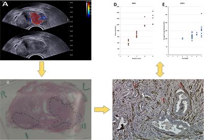 Multimodality Characterization of Cancer-Associated Fibroblasts in Tumor Microenvironment and Its Correlation With Ultrasound Shear Wave-Measured Tissue Stiffness in Localized Prostate Cancer